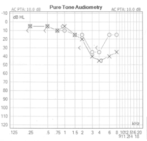 Audiogram of Doug Nordman showing a divergence between the ears of more than 15 decibels. | MilitaryFinancialIndependence.com
